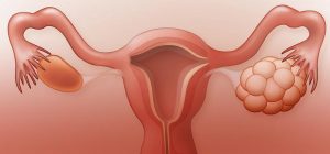 PCOS polycystic ovary syndrome ovarian symptom