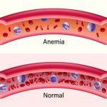 cara atasi anemia