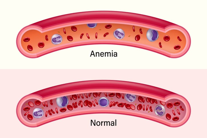 cara atasi anemia