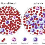 pengertian leukimia adalah