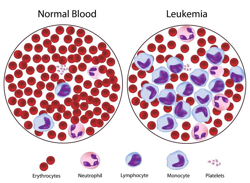 pengertian leukimia adalah