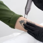 Rekomendasi Klinik Hapus Tato (Tatoo Removal) klinik tatto removal hapus tato